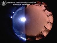 Appearance of clear graft after penetrating keratoplasty (PK)